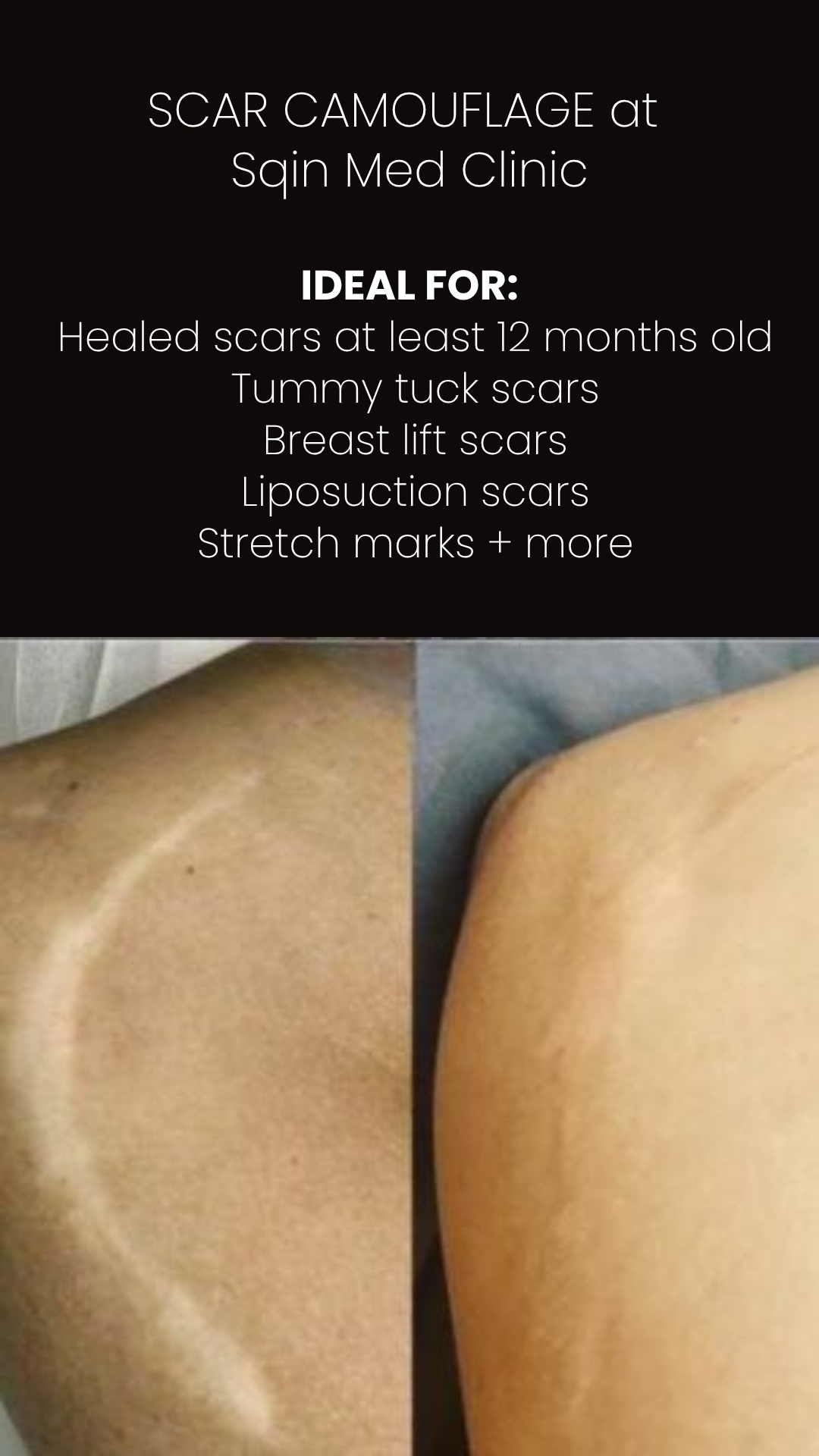 Surgical Scar Camouflage